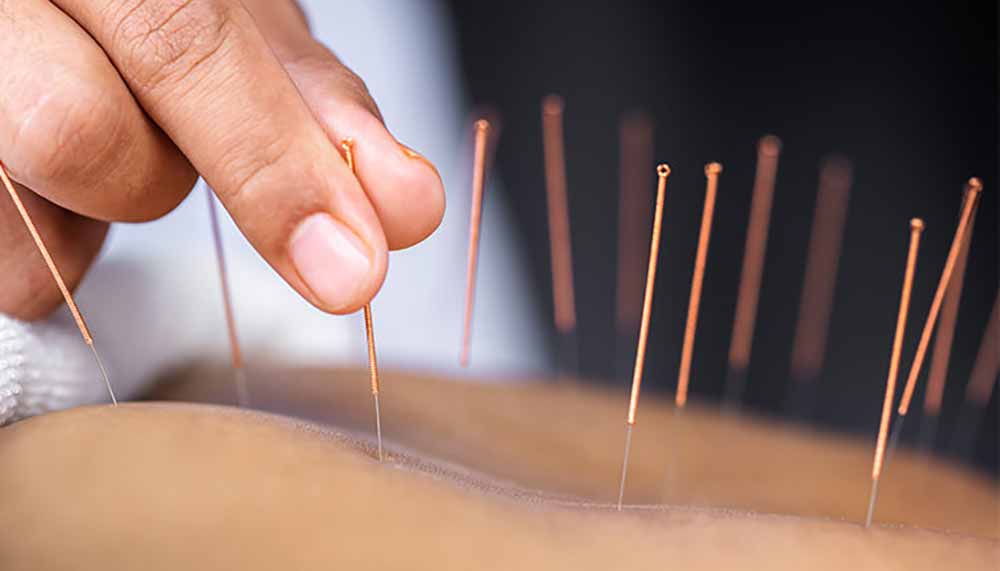 acupuncture-inflammation-of-the-bladder